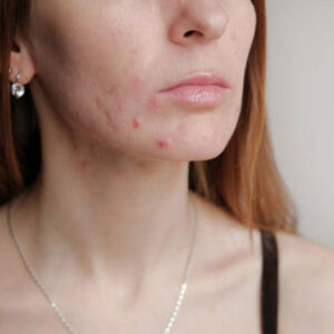Acne / Acne Spot Reduction